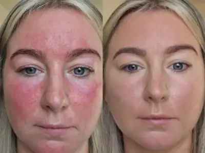 Rosacea Sufferers Praise £25 Cream That Makes Redness 'Disappear'