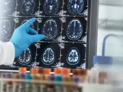 Alzheimer's drug trial to offer treatment to healthy adults