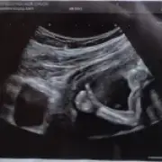 Baby's 'thumbs up' scan sign after fatal diagnosis warning