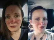 Ex model's 'life-changing' £14.99 cream for rosacea redness