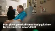 Man lives 271 days with pig kidney in world-first bridge transplant