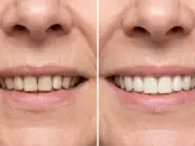 Tea-stained teeth 'so much whiter' with 32p-a-use whitening powder