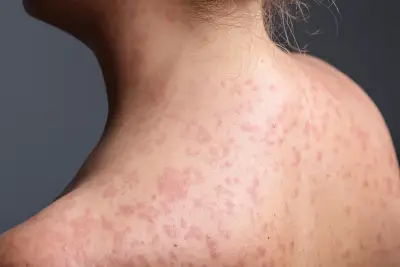 Pennsylvania measles outbreak tops 1,000 cases, worst in decades