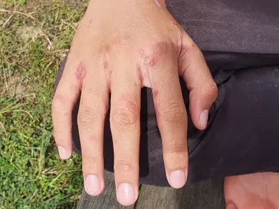 Scabies outbreak closes hospital wards as Victorian disease spreads