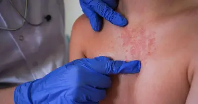 Scabies outbreak closes Welsh hospital ward as Victorian disease spreads