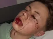 Teen who lost eye in firework accident urges others to listen